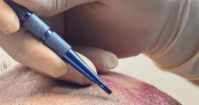 FUE: Follicular Unit Extraction
