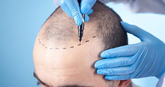DHI: Direct Hair Implantation